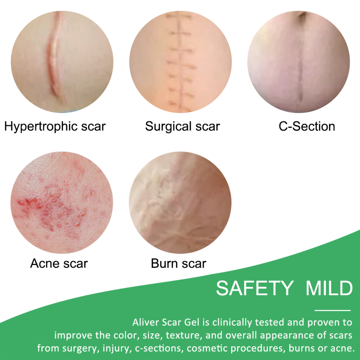 Our silicone scar removal sheets is harmless and comfortable, flexible and breathable