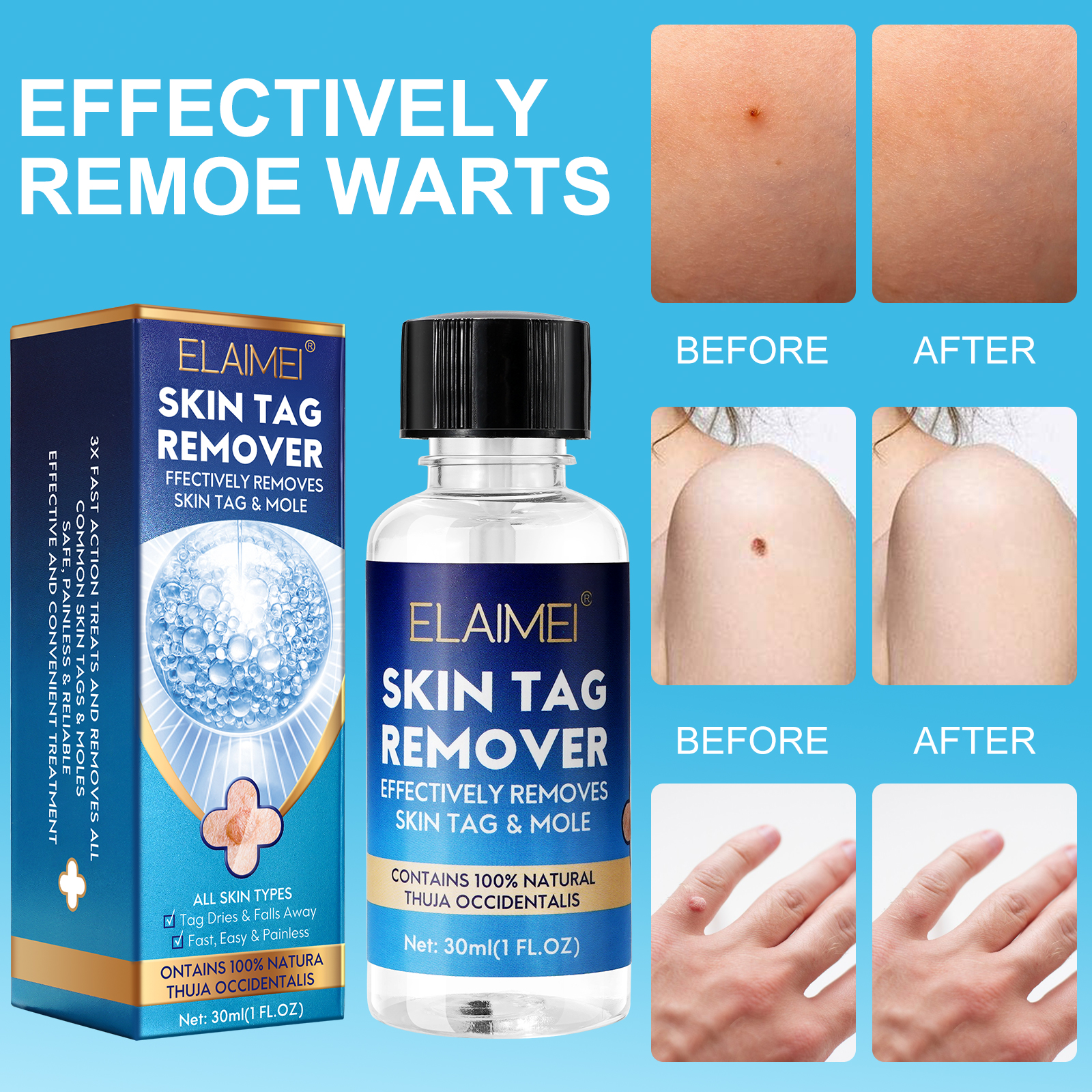 Elaimei Skin Tag Remover, 30ml