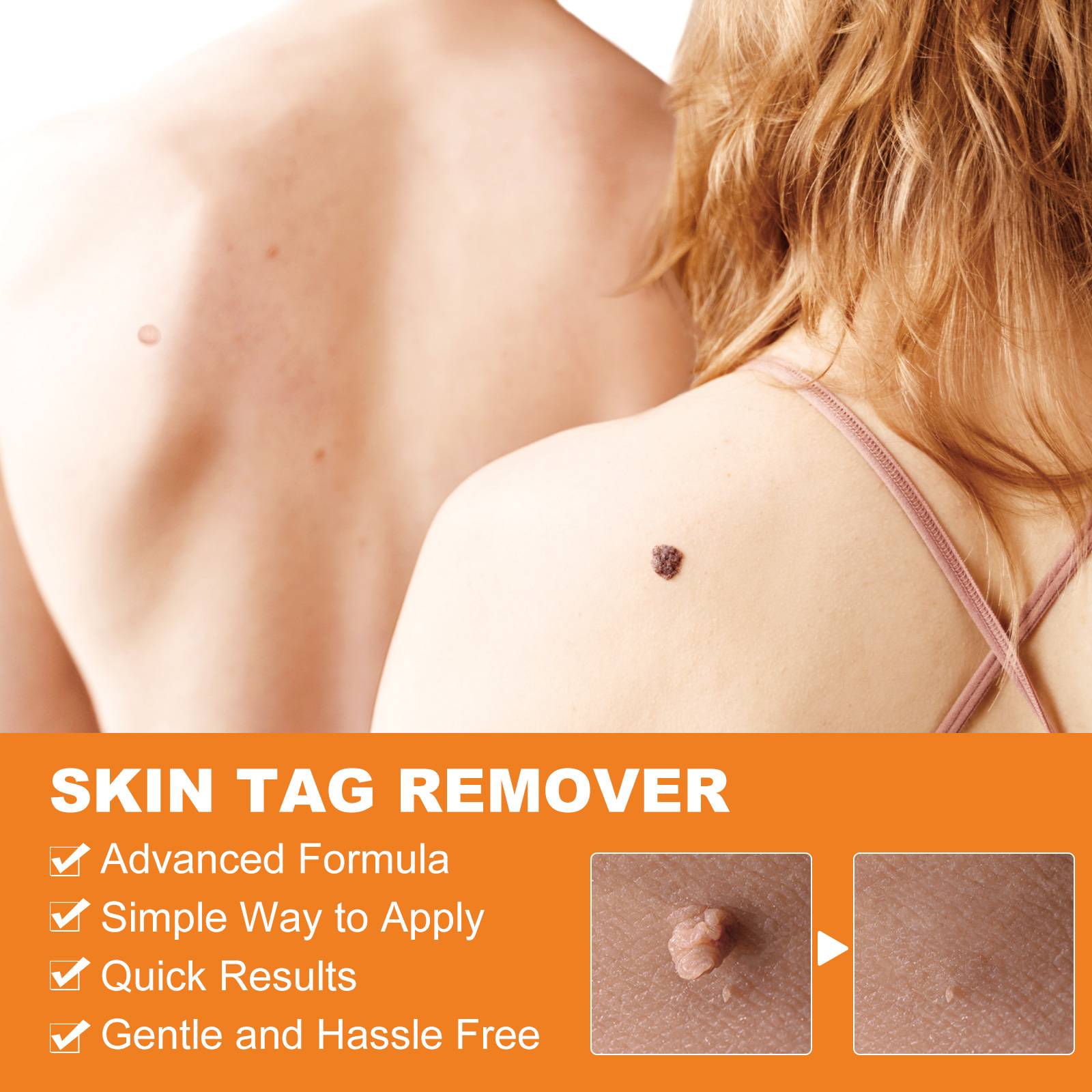 Elaimei Skin Tag Remover Kit Fast Effective Micro Safe Wart Removal Effective Bands