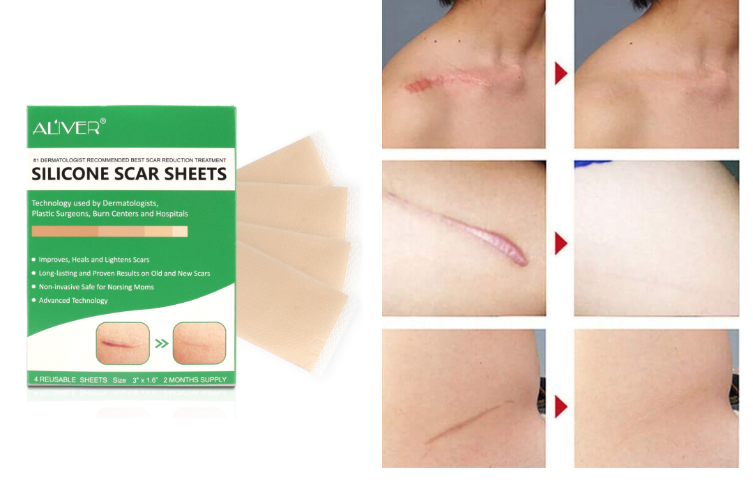 Scar Silicone Gel Sheet Patch Removal Skin Treatment Repair Wound Burn Efficient Medical Silicone Gel Strips Patch Scar Away Treatment Sheet Skin Repair