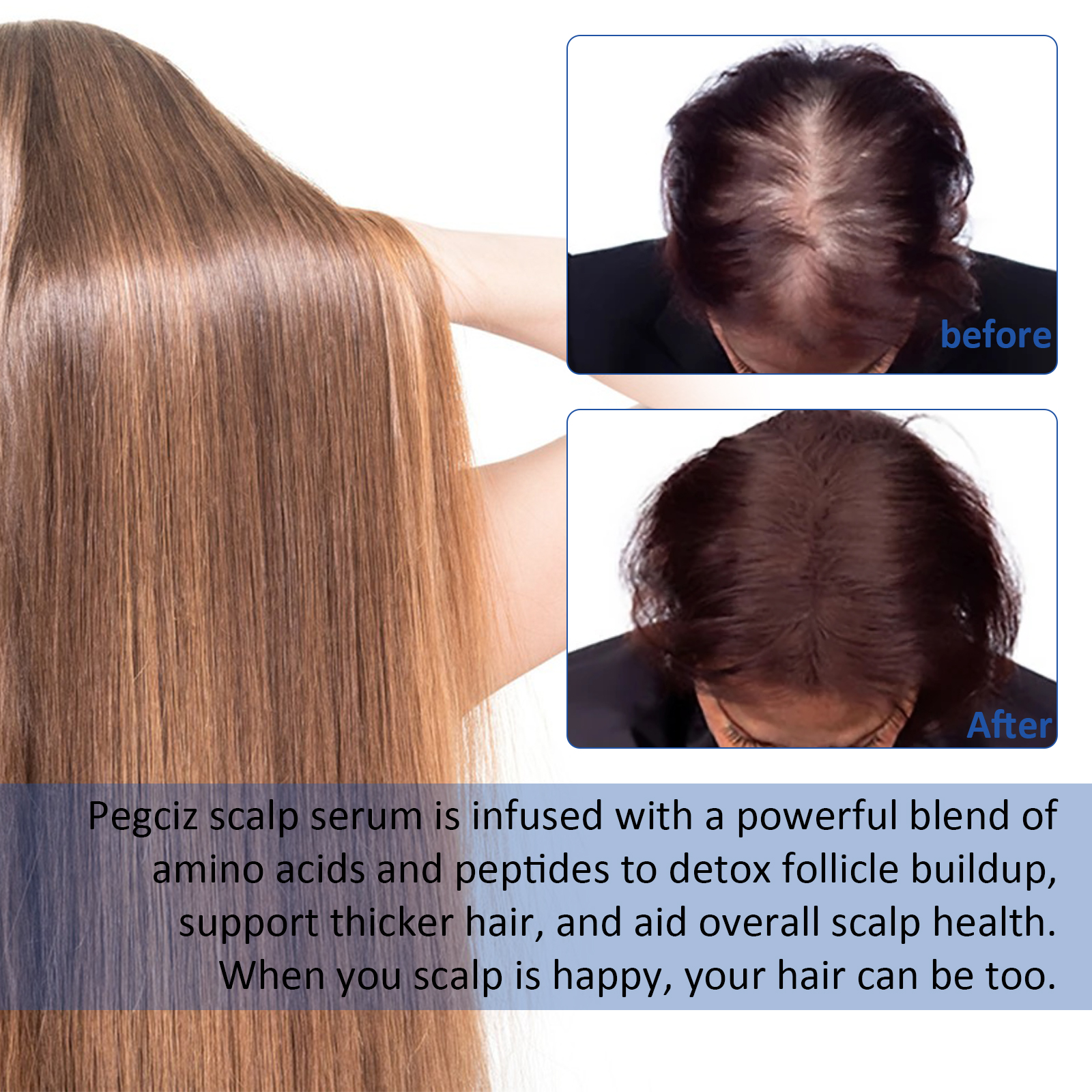 Pegciz Scalp Serum Hair Growth Dandruff Relief Stop Hair Loss Treatment Regrowth Oil Nourishing