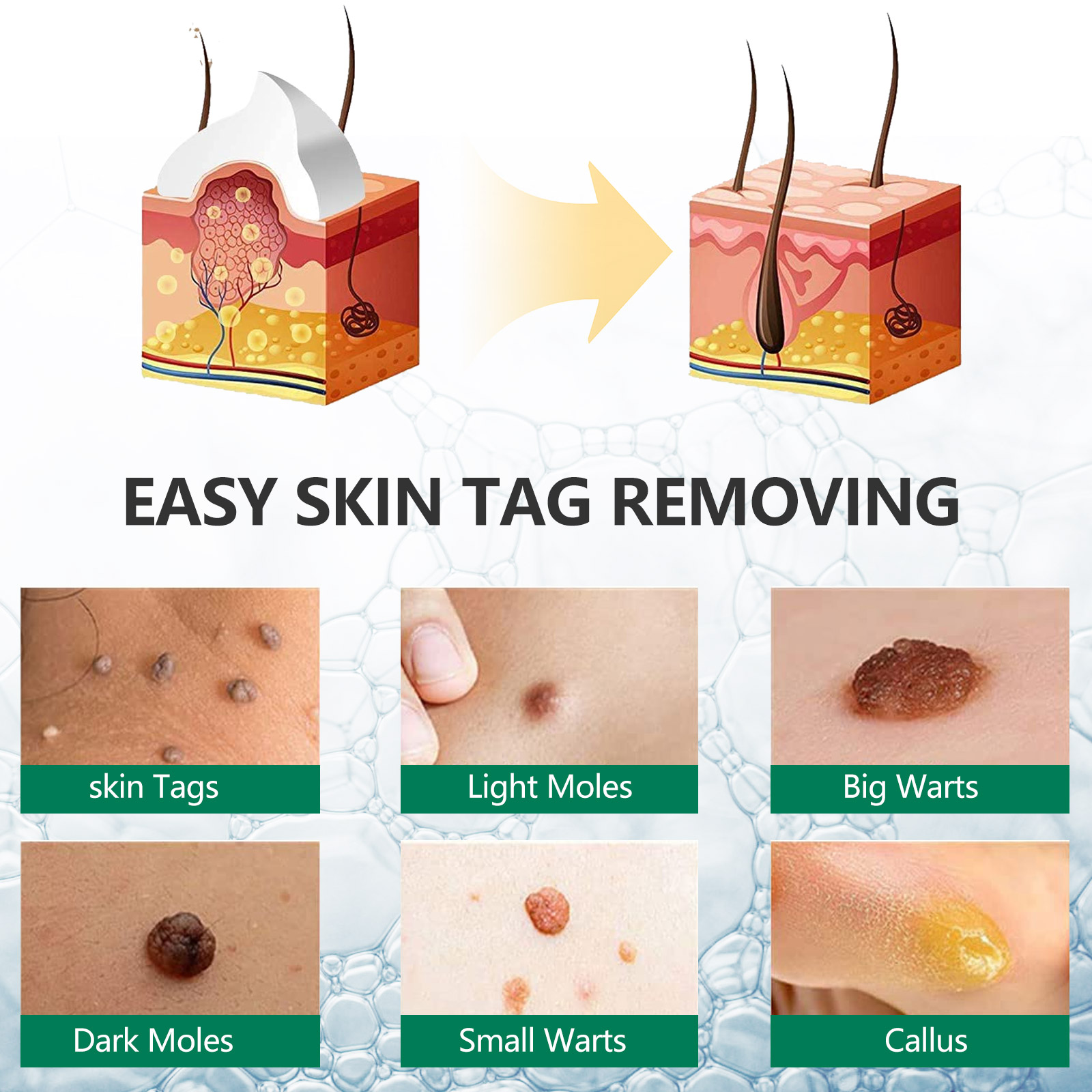 Elaimei Safe Skin Tag Remover Ointment Fast Mole Wart Removal Body Face Instant Treatment Fast Acting Natural Painless