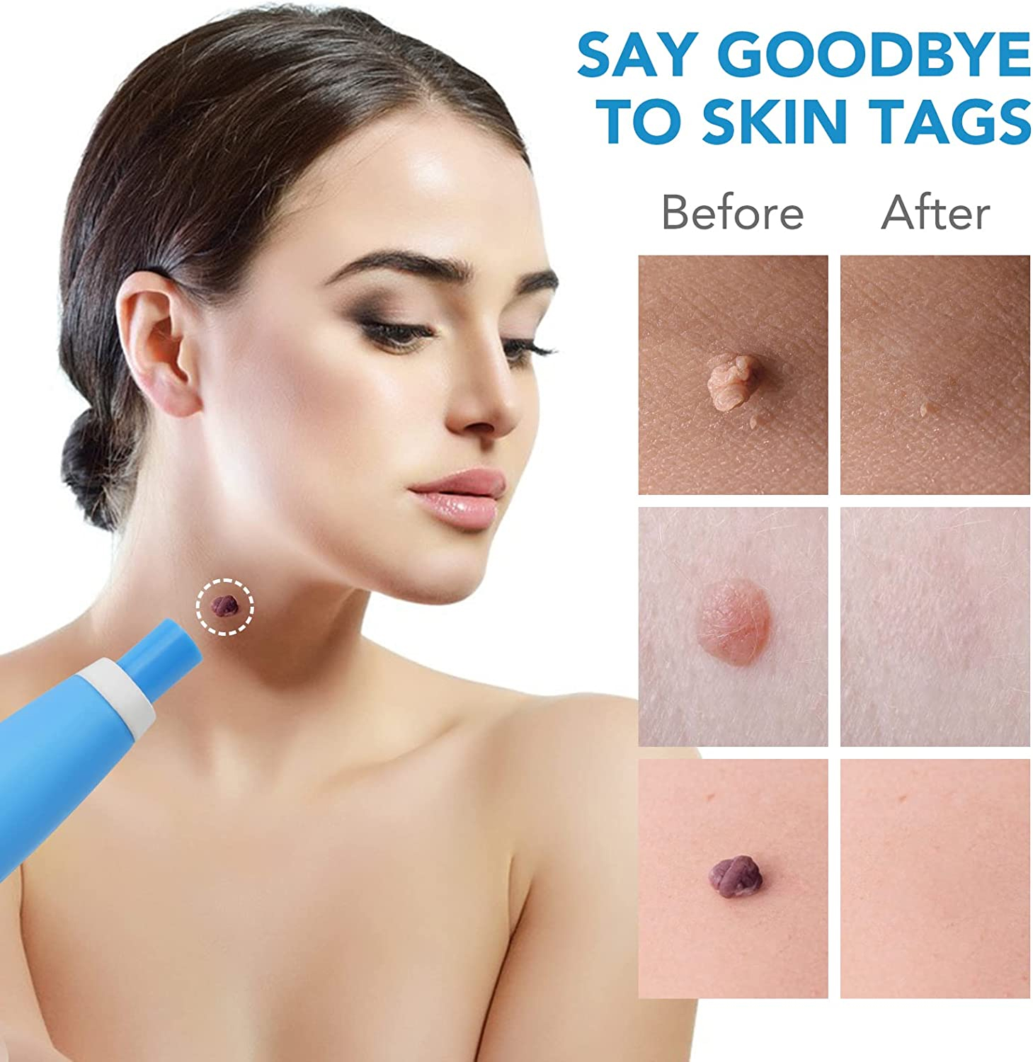 Skin Tag removal on neck Aliver