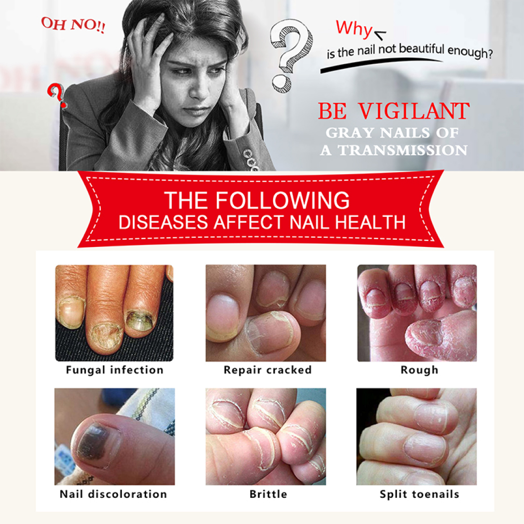 Anti Fungal Nail Treatment Repair Anti Infection Liquid Antibacterial Toe Finger