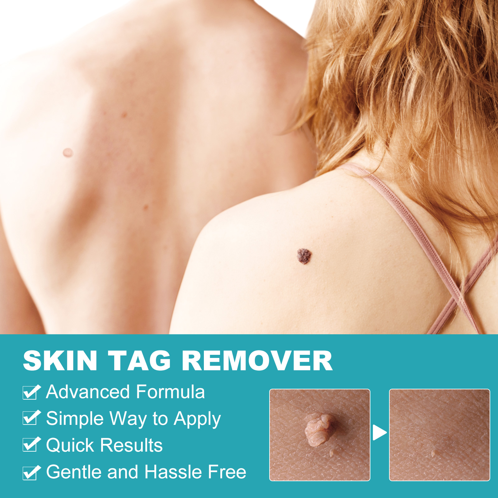 Elaimei Skin Tag Remover Kit Fast Effective Micro Safe Wart Removal Effective Bands