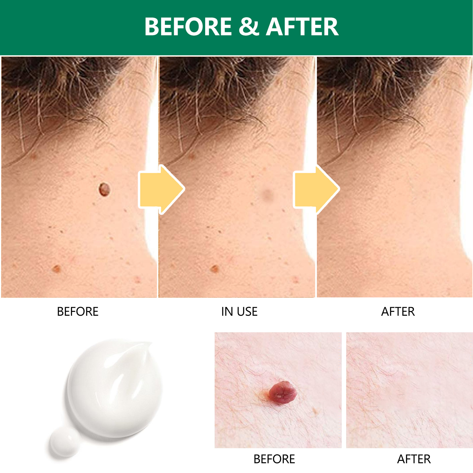 Elaimei Safe Skin Tag Remover Ointment Fast Mole Wart Removal Body Face Instant Treatment Fast Acting Natural Painless