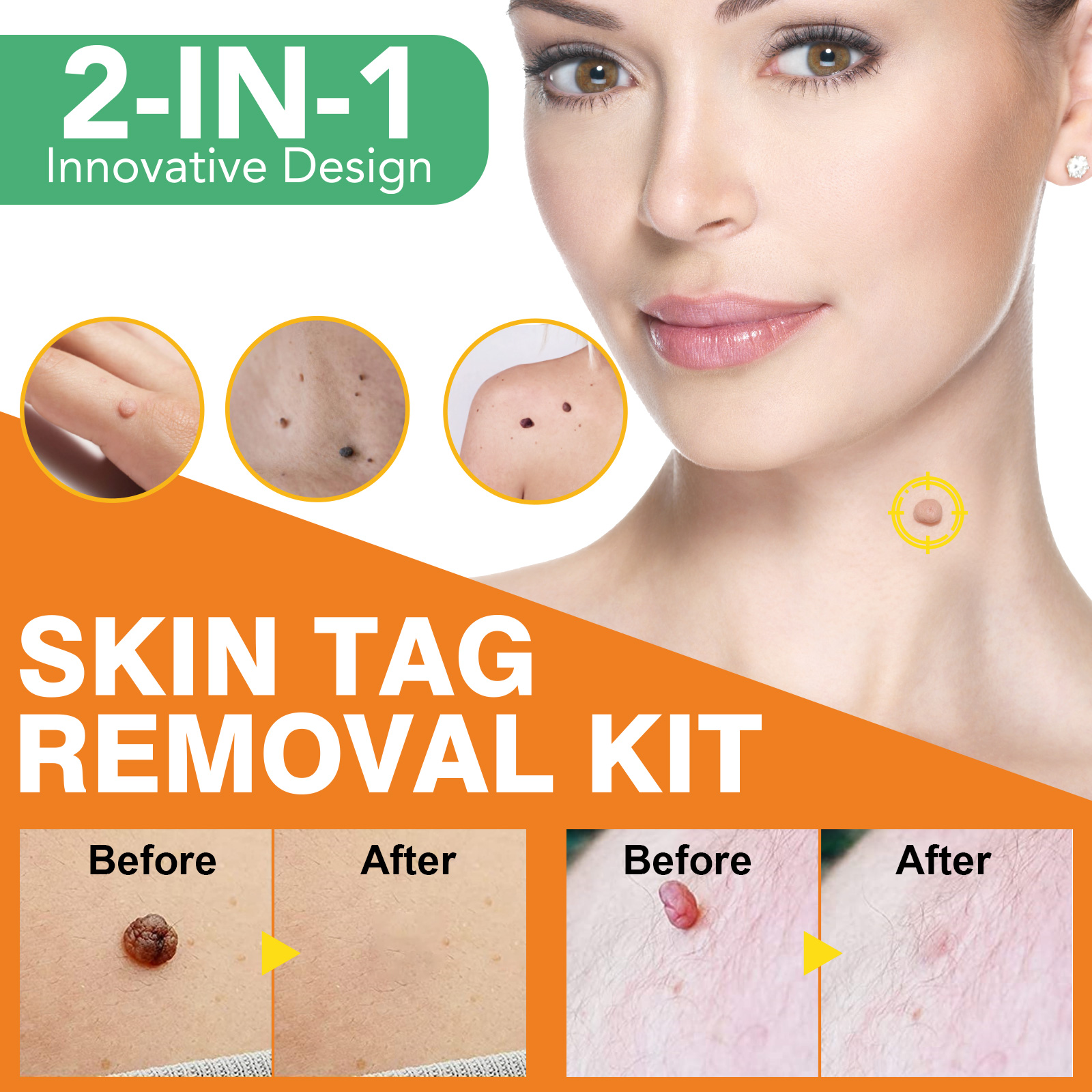 Elaimei Skin Tag Remover Kit Fast Effective Micro Safe Wart Removal Effective Bands